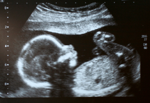 An infant affected with Meckel syndrome.